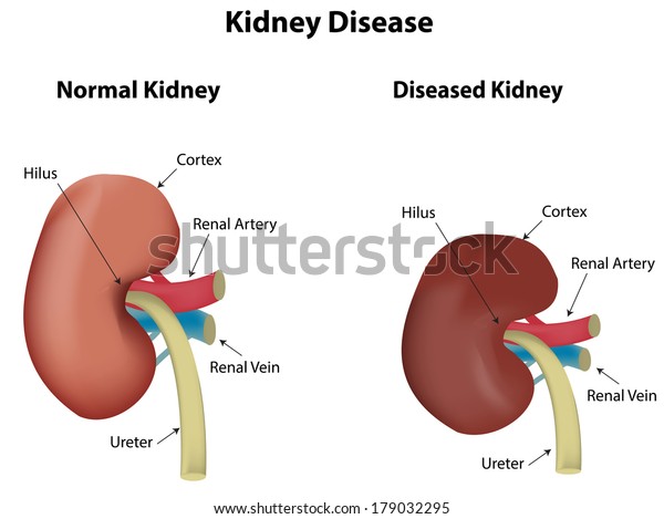 causes of kidney failure