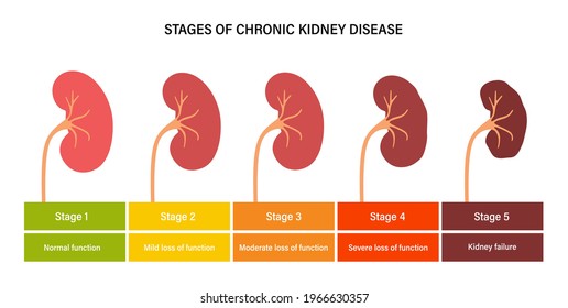 Kidney disease vector illustration. Stages of development of renal failure in the human body. Medical anatomical poster. Problem in urinary system and normal kidney. Internal organs exam concept.