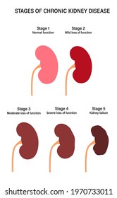 Kidney disease vector illustration. Stages of development of renal failure in the human body. Medical anatomical poster. Problem in urinary system and normal kidney. Internal organs exam concept.