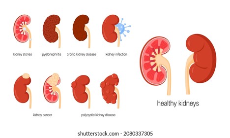 Kidney diseases. Set of anatomical icons for medical designs. Vector illustration isolated on a white background in cartoon style.