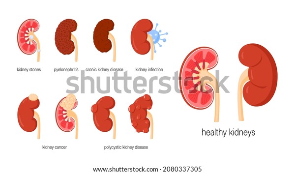 Kidney Diseases Set Anatomical Icons Medical Stock Vector (Royalty Free ...