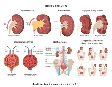 Enfermedades renales. Insuficiencia renal, patología médica de órganos y sistemas urinarios. Anomalía congénita o trastorno funcional. Piedras renales, síndrome poliístico, hidronefrosis. Ilustración vectorial plana