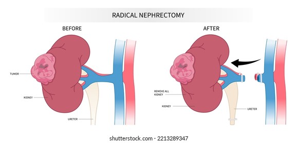 Radikale vollständige Nephrektomie-Operation, um alle Teile der Niere in der Medizin zu entfernen