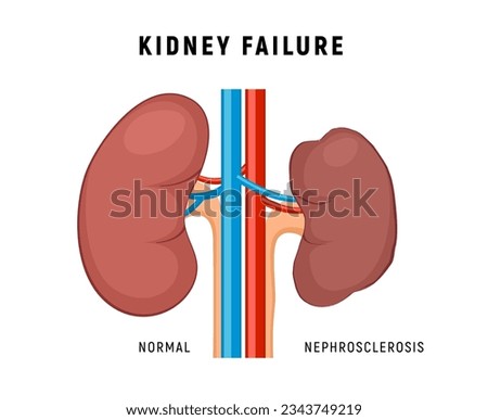 Kidney failure chronic disease urinary renal cancer. Kidney failure nephritis nephrosclerosis