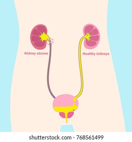 kidney with healthy problem on the blue background