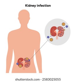 Kidney infection urology urinary problem. Medical diagram 