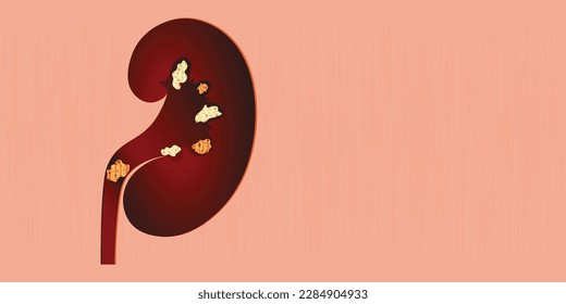 a kidney model with stones in it. kidney treatment banner, poster vector illustration.