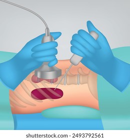 Punción de riñón. Ilustración visual del procedimiento con el paciente y las manos del médico. Cartel médico. Ilustración vectorial