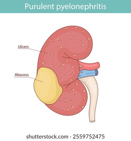 Kidney pyelonephritis, kidney abscess and ulcers. vector medical illustration