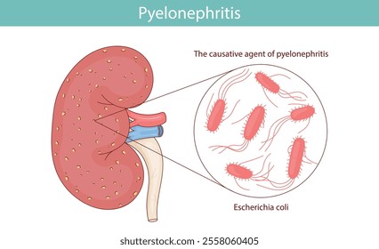Kidney pyelonephritis, caused by Escherichia coli. vector medical illustration