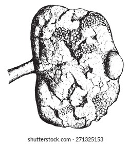 Kidney showing advanced chronic interstitial nephritis, vintage engraved illustration. 