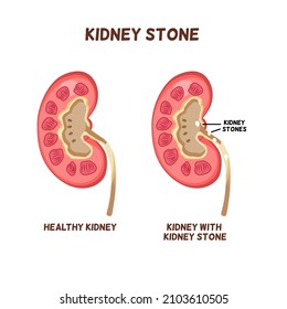 Piedra renal, 2 riñón humano muestra diferentes objetos que uno es normal comparado con el riñón con la piedra interior