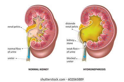 Kidney stone blocked ureter (hydronephrosis)