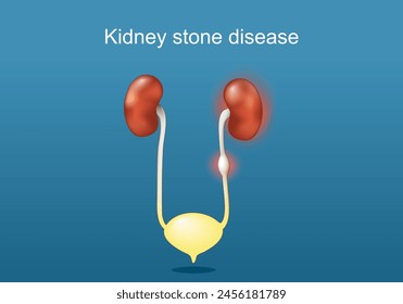 Enfermedad de los cálculos renales. Anatomía del sistema urinario humano. Riñones, uréter con cálculos, vejiga urinaria y uretra. Cálculos renales. Afiche del Vector. Ilustración plana isométrica.