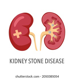 Kidney stone disease concept vector illustration on white background.