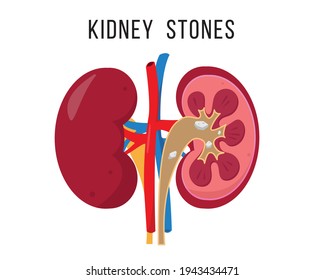 Kidney Stone Disease. Human Kidneys Anatomy Inside And Outside. Internal Organ Icon Isolated On White Background. Medical Concept Of Diseased Urinary System. Vector Illustration.