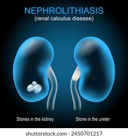 Kidney stone disease. Renal calculus disease. Nephrolithiasis or urolithiasis. Vector illustration like X-ray image for healthcare design. Realistic transparent blue kidney with stones
