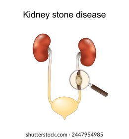 Kidney stone disease. Renal colic. Human Urinary System. Magnifying glass and Close-up of a stone into Ureter. vector illustration isolated on white background.