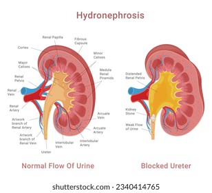 Kidney stone normal flow of urine and blocked ureter medical scheme poster isometric vector illustration. Anatomy human disease internal organ health and problem biology disorder science education