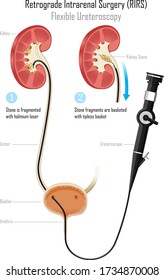 kidney stone treatment with flexible Ureteroscope