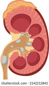 kidney stones flat vector illustration