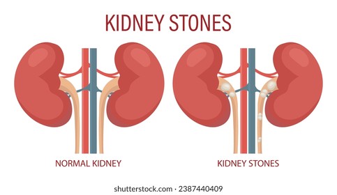 Kidney stones. Human kidney disease. Medical infographic banner, illustration, vector
