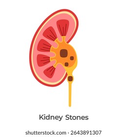 Kidney stones kidneys problem stone clogging urinary anatomy drawing illustration 