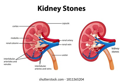 Kidney stones symptoms cartoon style infographic illustration
