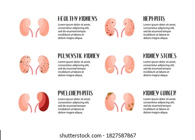 Kidneys diseases. Polycystic kidney, pyelonephritis, nephritis, stones, cancer. Urology. Vector flat illustration. Perfect for flyer, medical brochure, banner, landing page, website