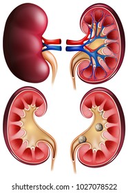 Kidneys and kidney stones on poster illustration