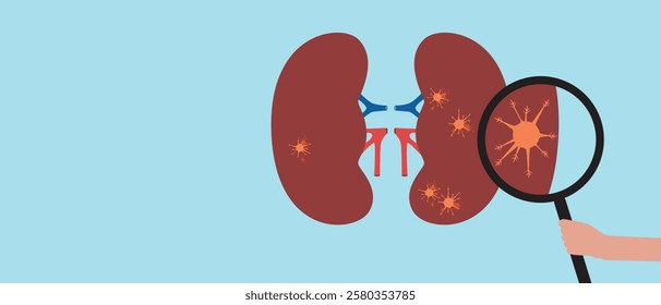 Kidneys with malignant tumor as oncology concept, flat vector stock illustration or copy space template with kidney cancer