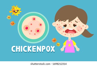 chicken pox virus