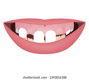 Kids jaws with gummy smile, crooked lower teeth and distal bite before the orthotropics or orthotropics treatment. Vector illustration