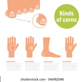 Kinds of corns. Callosity, callus. Vector. Cartoon. Isolated. Flat. Illustration for websites, brochures, magazines. Medicine