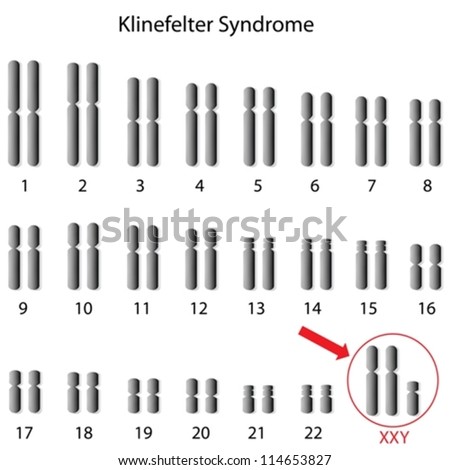 Klinefelter syndrome
