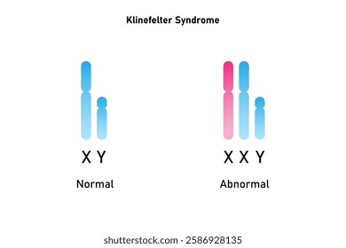Klinefelter Syndrome Science Design. Vector Illustration.