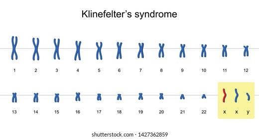 Klinefelter's Syndrome Karyotype, Nondisjunction Of Sex Chromosomes, XXY