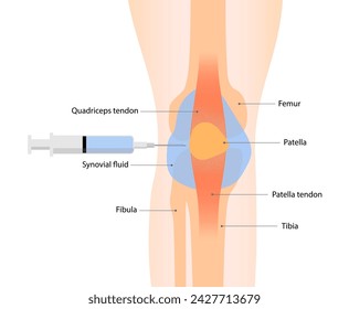 Knee arthrocentesis or synovial fluid aspiration for relieve pain and swelling caused by conditions like arthritis or injury. Medical procedure vector illustration isolated on white background.