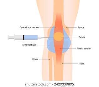 Knee arthrocentesis or synovial fluid aspiration for relieve pain and swelling caused by conditions like arthritis or injury. Medical procedure vector illustration isolated on white background.