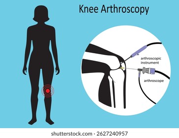 Knee Arthroscopy Procedure for Joint Surgery – Arthroscope and Arthroscopic Instruments in Use. Treatment for Leg Pain, Inflammation, and Cartilage Repair. Medical Vector Illustration
