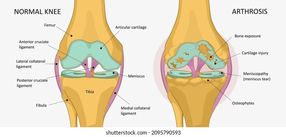 Knee arthrosis. Healthy knee and sore knee with damaged structure 