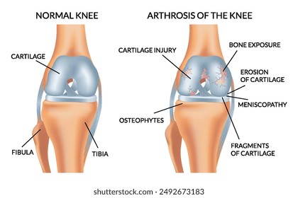 Knee arthrosis. Healthy knee and sore knee with damaged structure. Bone exposure damaged and healthy knee structure comparison. Medical poster with foot bones. Isolated vector illustration