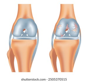 Knee arthrosis. Healthy knee and sore knee with damaged structure. Bone exposure damaged and healthy knee structure comparison. Medical poster with foot bones. Isolated vector illustration