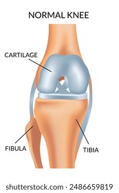 Knee arthrosis. Healthy knee structure. Bone exposure, healthy knee structure comparison. Medical poster with foot bones. Isolated vector illustration