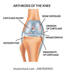 Knee arthrosis. Unhealthy knee structure. Bone exposure, damaged knee structure comparison. Medical poster with foot bones. Isolated vector illustration