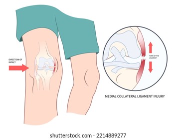 Knee athletic meniscal femur Injury test Medial collateral ligament pop Grade hurt