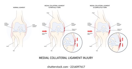 Knee athletic meniscal femur Injury test Medial collateral ligament pop Grade hurt