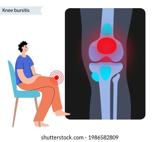 Knee bursitis inflammation. Inflamed bursa in human leg. Patella, kneecap disease, pain and deformity. Diagnosis and injection treatment. Anatomical musculoskeletal poster, medical vector illustration