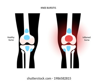 Knee bursitis inflammation. Inflamed bursa in human leg. Patella, kneecap disease, pain and deformity. Diagnosis and injection treatment. Anatomical musculoskeletal poster, medical vector illustration