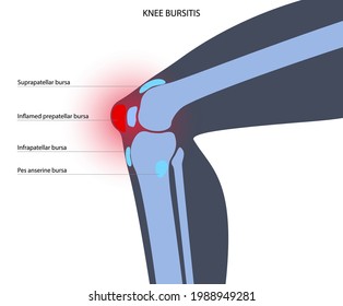 Knee bursitis inflammation. Inflamed bursa in human leg. Patella, kneecap disease, pain and deformity. Diagnosis and injection treatment. Anatomical musculoskeletal poster, medical vector illustration